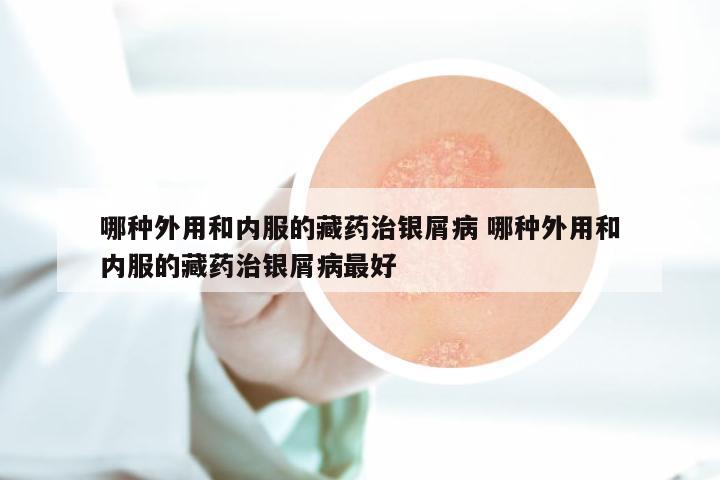哪种外用和内服的藏药治银屑病 哪种外用和内服的藏药治银屑病最好