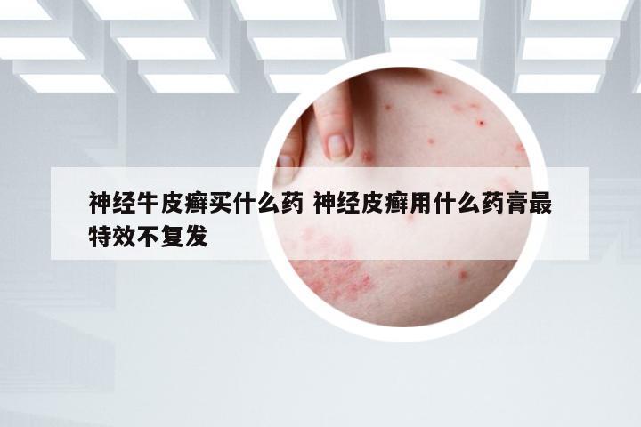 神经牛皮癣买什么药 神经皮癣用什么药膏最特效不复发