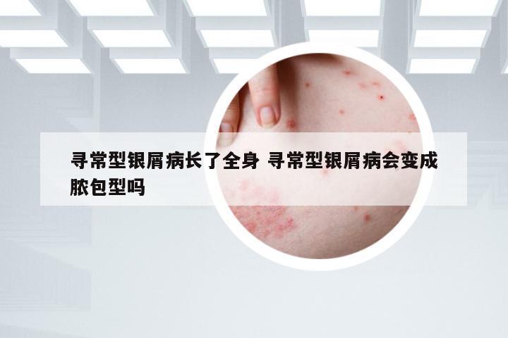 寻常型银屑病长了全身 寻常型银屑病会变成脓包型吗