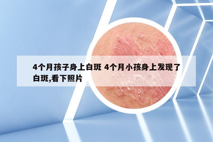 4个月孩子身上白斑 4个月小孩身上发现了白斑,看下照片