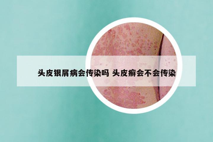 头皮银屑病会传染吗 头皮癣会不会传染