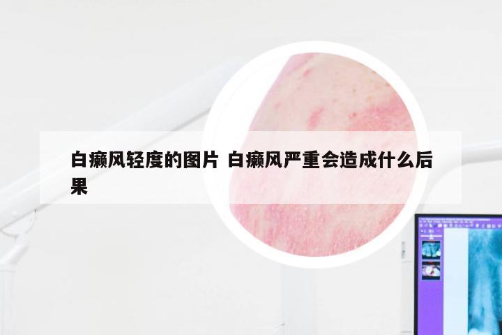 白癞风轻度的图片 白癞风严重会造成什么后果