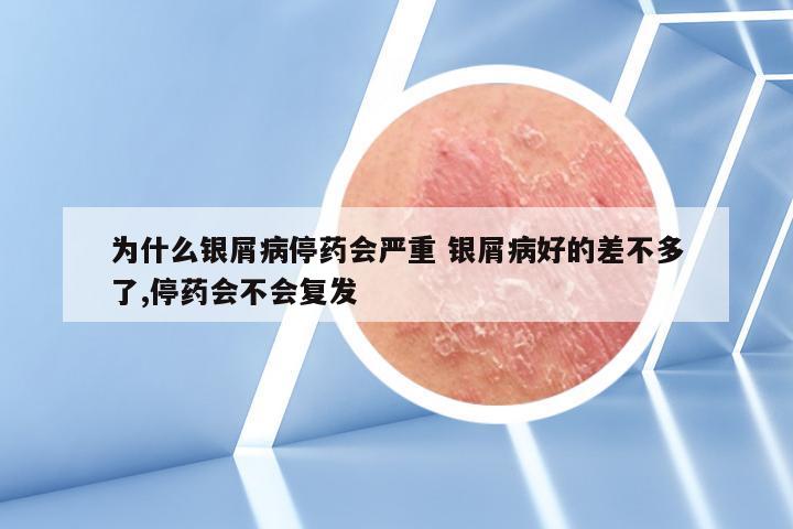 为什么银屑病停药会严重 银屑病好的差不多了,停药会不会复发