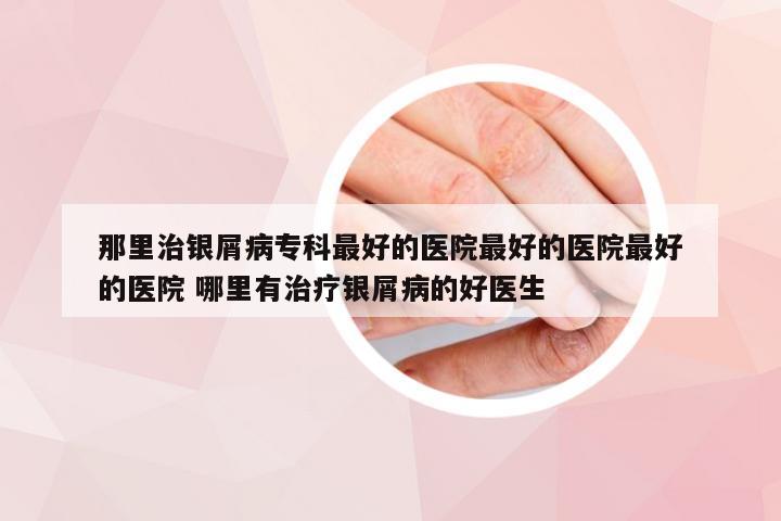 那里治银屑病专科最好的医院最好的医院最好的医院 哪里有治疗银屑病的好医生