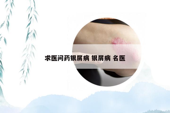 求医问药银屑病 银屑病 名医