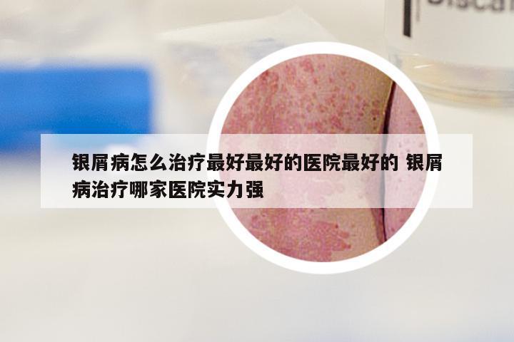 银屑病怎么治疗最好最好的医院最好的 银屑病治疗哪家医院实力强