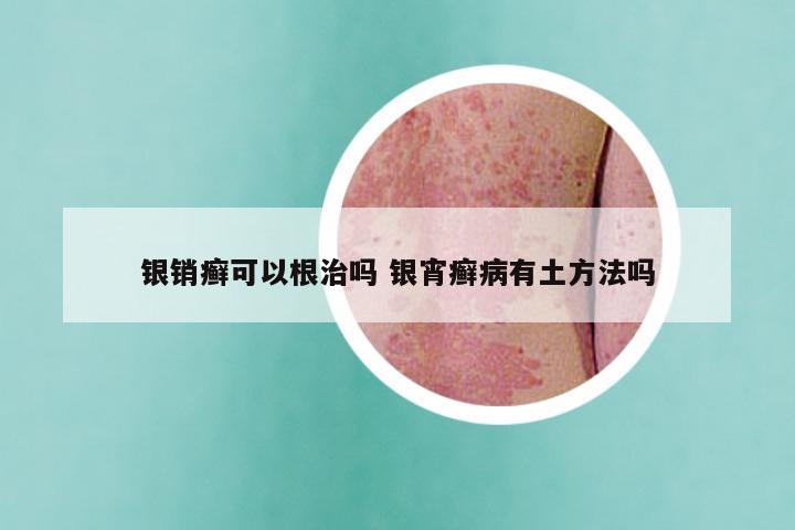 银销癣可以根治吗 银宵癣病有土方法吗