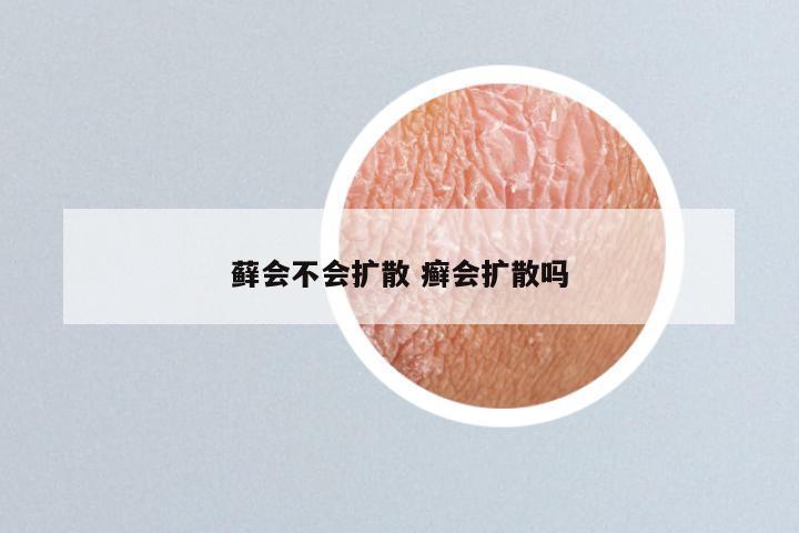 藓会不会扩散 癣会扩散吗