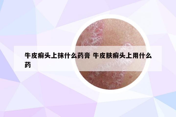 牛皮癣头上抹什么药膏 牛皮肤癣头上用什么药