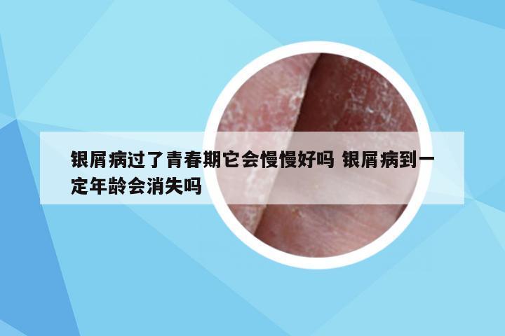 银屑病过了青春期它会慢慢好吗 银屑病到一定年龄会消失吗