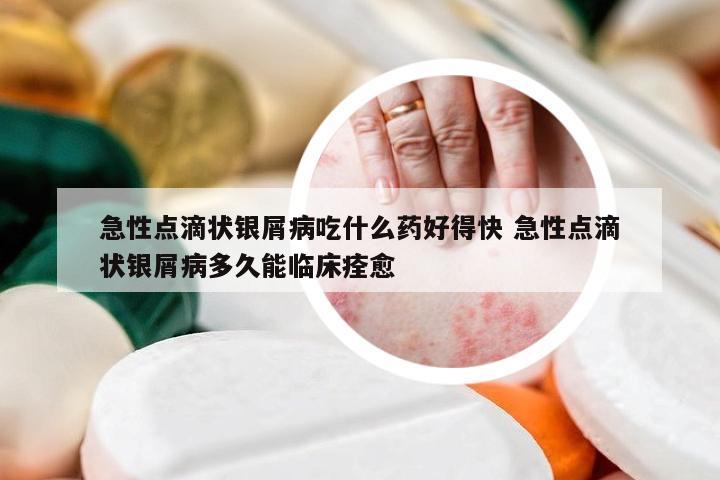 急性点滴状银屑病吃什么药好得快 急性点滴状银屑病多久能临床痊愈