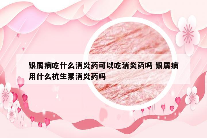 银屑病吃什么消炎药可以吃消炎药吗 银屑病用什么抗生素消炎药吗