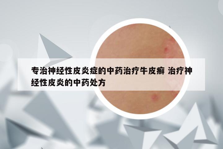 专治神经性皮炎症的中药治疗牛皮癣 治疗神经性皮炎的中药处方