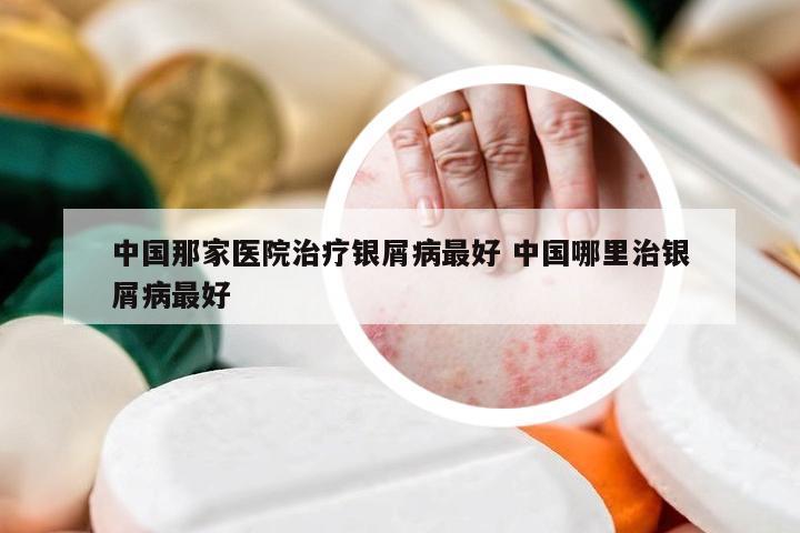 中国那家医院治疗银屑病最好 中国哪里治银屑病最好