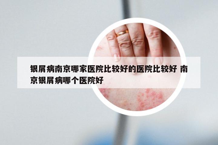 银屑病南京哪家医院比较好的医院比较好 南京银屑病哪个医院好