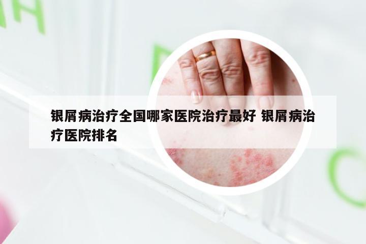 银屑病治疗全国哪家医院治疗最好 银屑病治疗医院排名