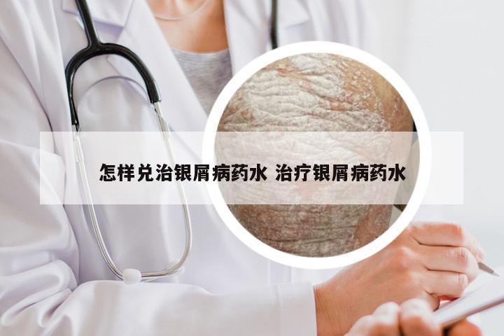 怎样兑治银屑病药水 治疗银屑病药水