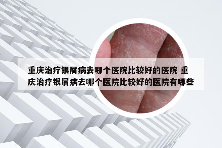 重庆治疗银屑病去哪个医院比较好的医院 重庆治疗银屑病去哪个医院比较好的医院有哪些