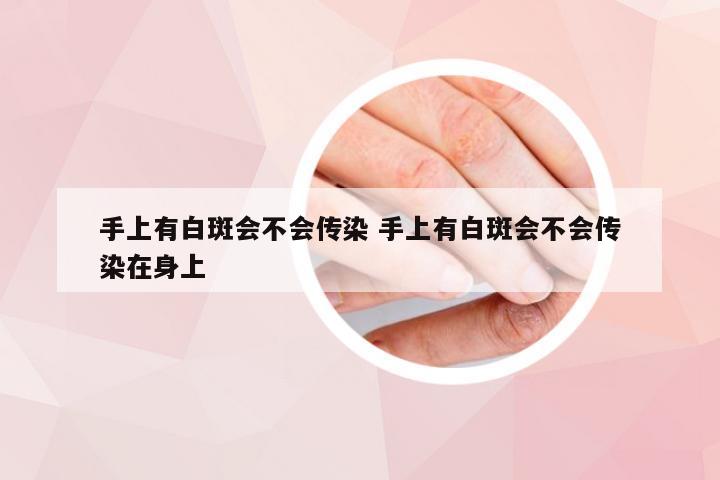 手上有白斑会不会传染 手上有白斑会不会传染在身上