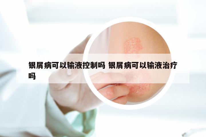 银屑病可以输液控制吗 银屑病可以输液治疗吗