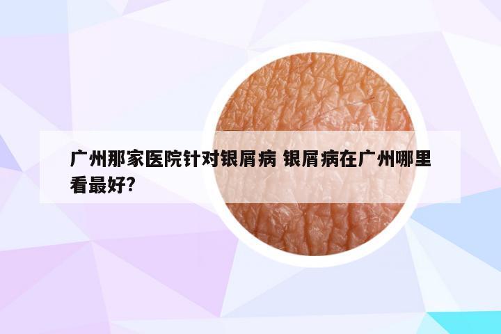 广州那家医院针对银屑病 银屑病在广州哪里看最好?