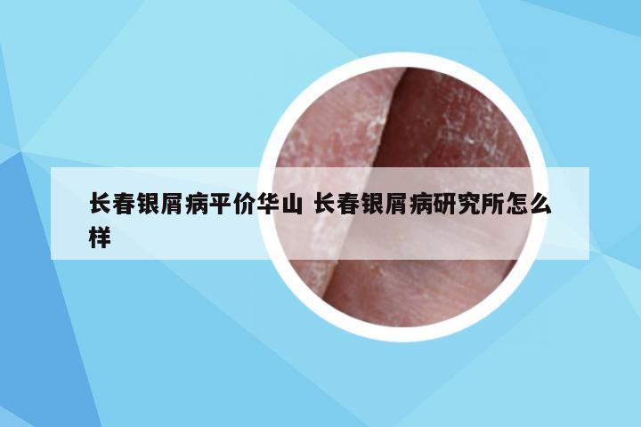 长春银屑病平价华山 长春银屑病研究所怎么样