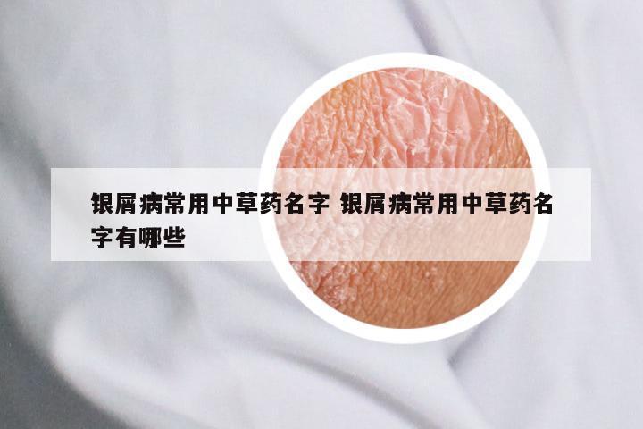 银屑病常用中草药名字 银屑病常用中草药名字有哪些