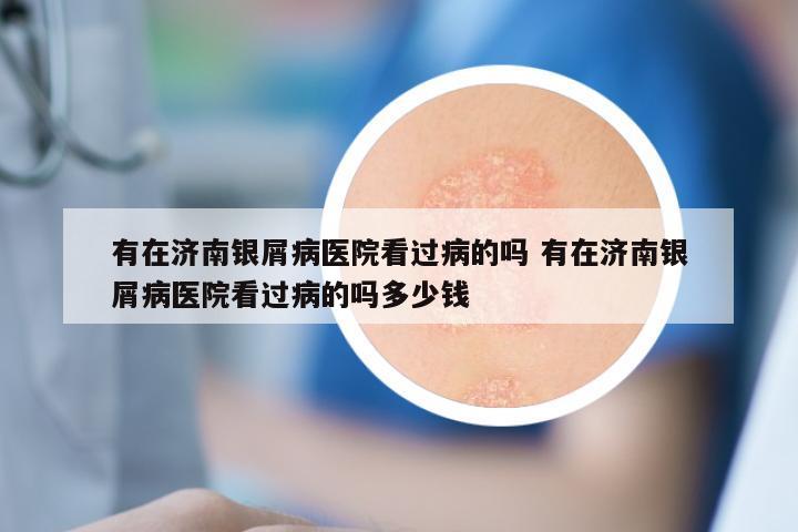 有在济南银屑病医院看过病的吗 有在济南银屑病医院看过病的吗多少钱