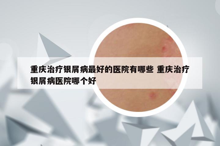 重庆治疗银屑病最好的医院有哪些 重庆治疗银屑病医院哪个好