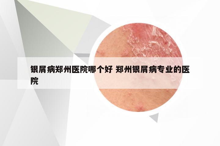 银屑病郑州医院哪个好 郑州银屑病专业的医院