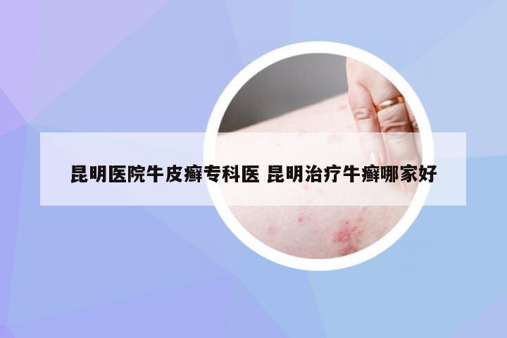 昆明医院牛皮癣专科医 昆明治疗牛癣哪家好