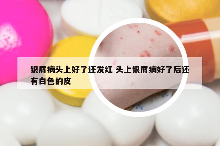 银屑病头上好了还发红 头上银屑病好了后还有白色的皮