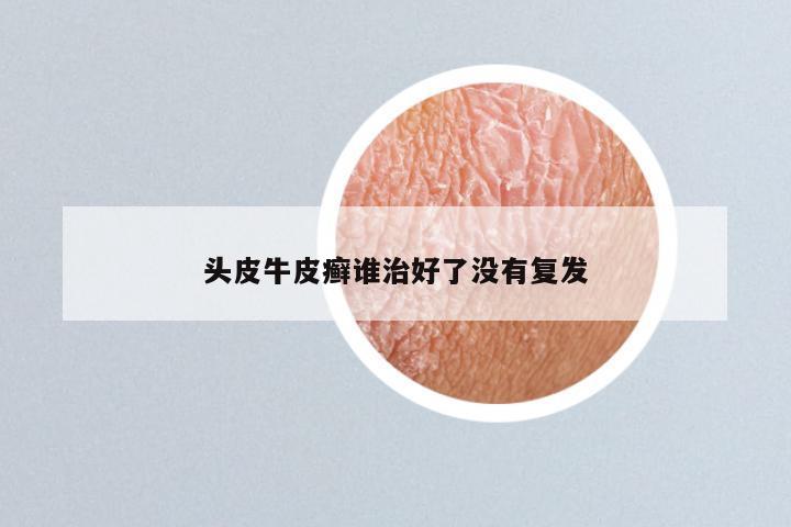 头皮牛皮癣谁治好了没有复发