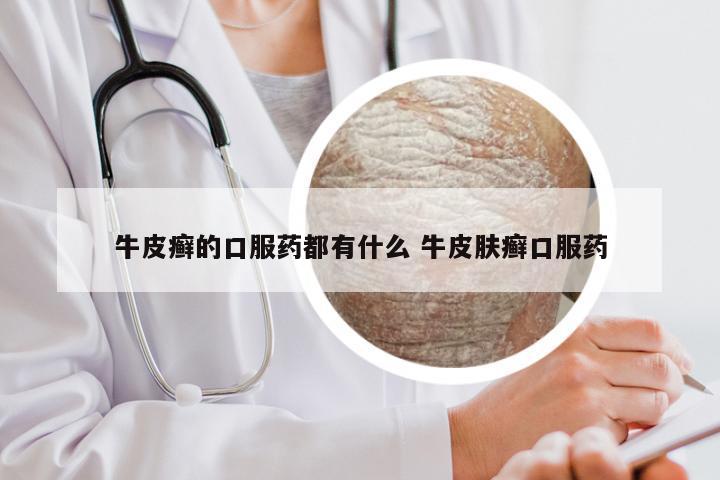 牛皮癣的口服药都有什么 牛皮肤癣口服药