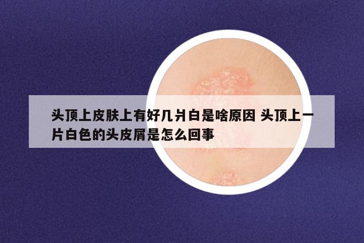 头顶上皮肤上有好几爿白是啥原因 头顶上一片白色的头皮屑是怎么回事
