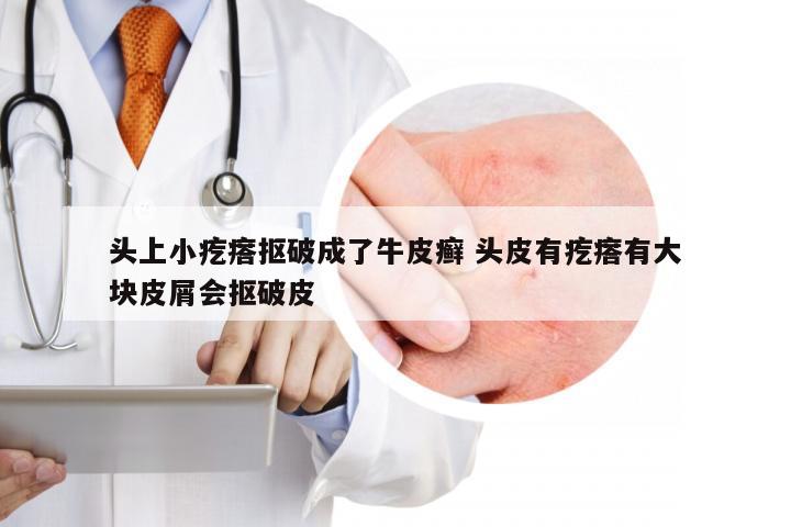 头上小疙瘩抠破成了牛皮癣 头皮有疙瘩有大块皮屑会抠破皮