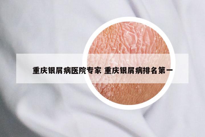 重庆银屑病医院专家 重庆银屑病排名第一