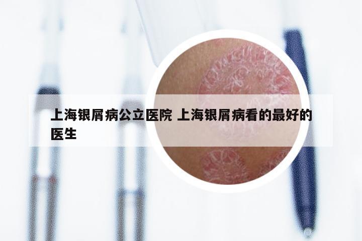 上海银屑病公立医院 上海银屑病看的最好的医生