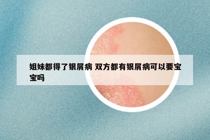 姐妹都得了银屑病 双方都有银屑病可以要宝宝吗