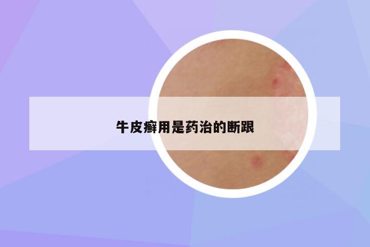 牛皮癣用是药治的断跟
