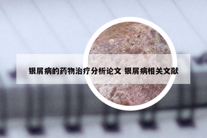 银屑病的药物治疗分析论文 银屑病相关文献