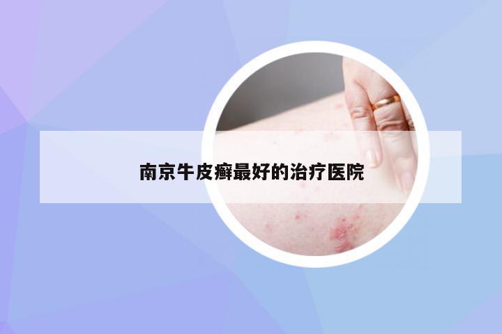 南京牛皮癣最好的治疗医院