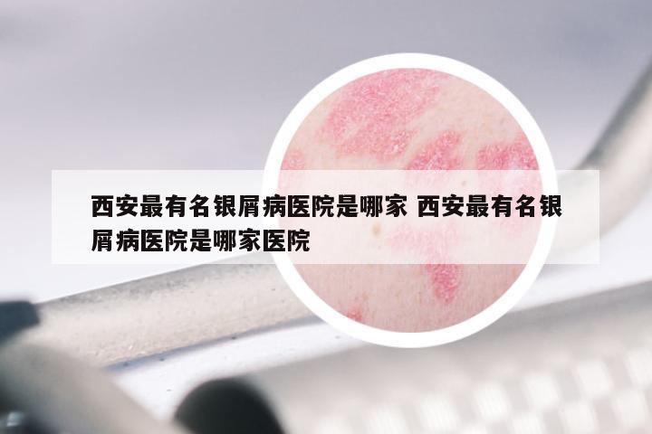 西安最有名银屑病医院是哪家 西安最有名银屑病医院是哪家医院