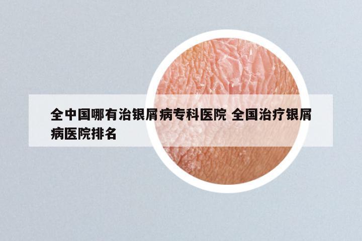 全中国哪有治银屑病专科医院 全国治疗银屑病医院排名
