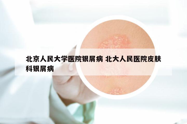 北京人民大学医院银屑病 北大人民医院皮肤科银屑病