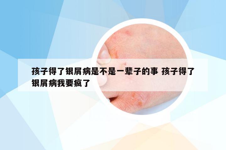 孩子得了银屑病是不是一辈子的事 孩子得了银屑病我要疯了
