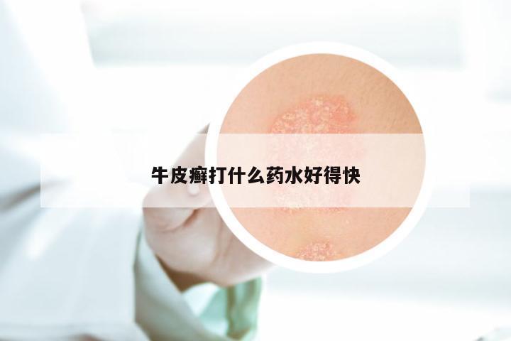 牛皮癣打什么药水好得快