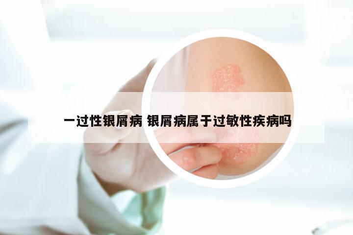 一过性银屑病 银屑病属于过敏性疾病吗