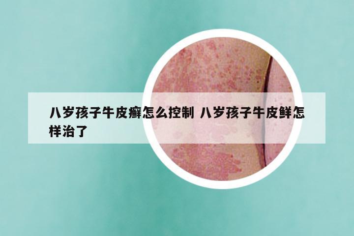 八岁孩子牛皮癣怎么控制 八岁孩子牛皮鲜怎样治了