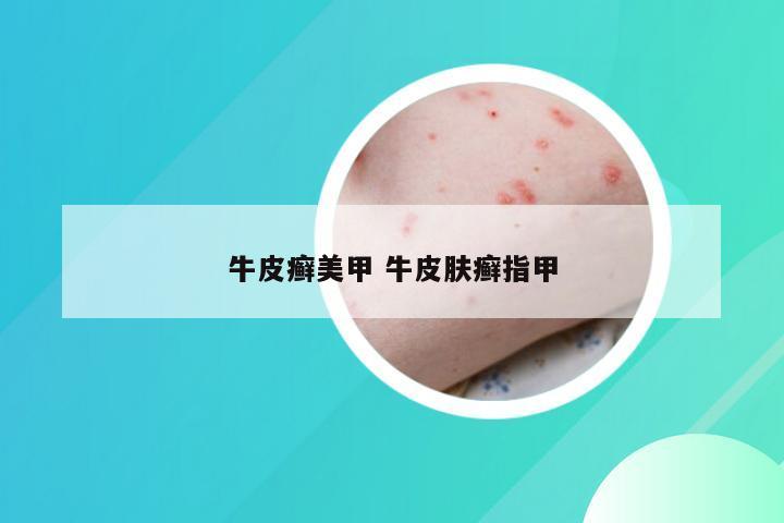 牛皮癣美甲 牛皮肤癣指甲